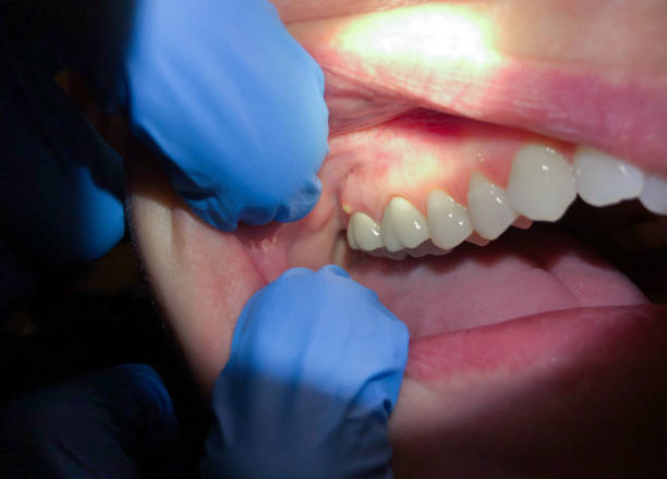 Best Emergency Dentist for Knocked-Out Tooth in Clinton, IA